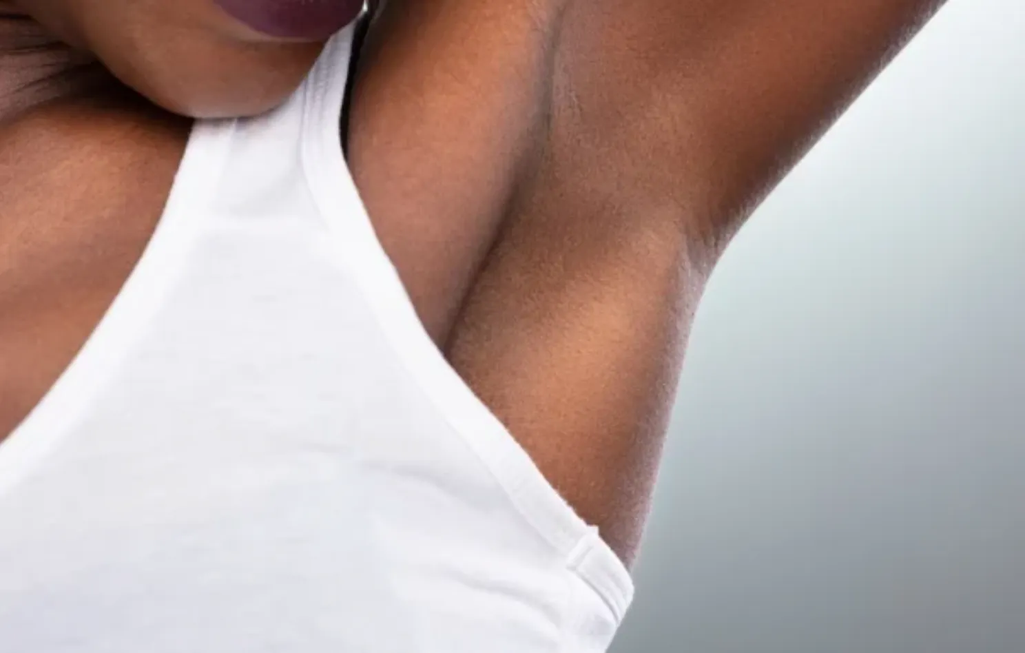 Underarm hyperhidrosis treatment area